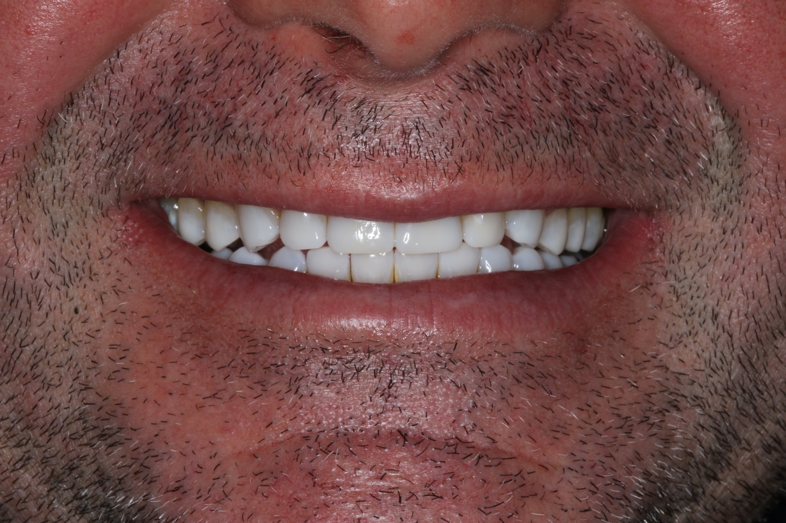 Katy Smile Design | Crowns  amp  Caps, Night Guards and OralID reg  Cancer Screening