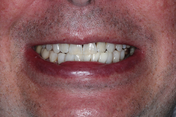 Katy Smile Design | K  R Whitening, Invisalign reg  and Fluoride Treatment