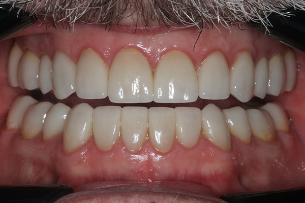 Katy Smile Design | Digital Radiography, Fluoride Treatment and Teeth Whitening