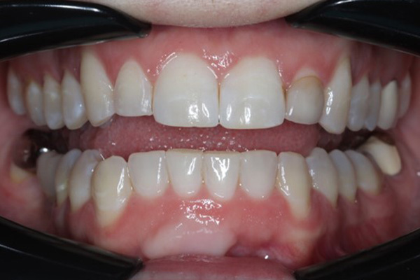 Katy Smile Design | Cosmetic Dentistry, Oral Cancer Screening and OralID reg  Cancer Screening