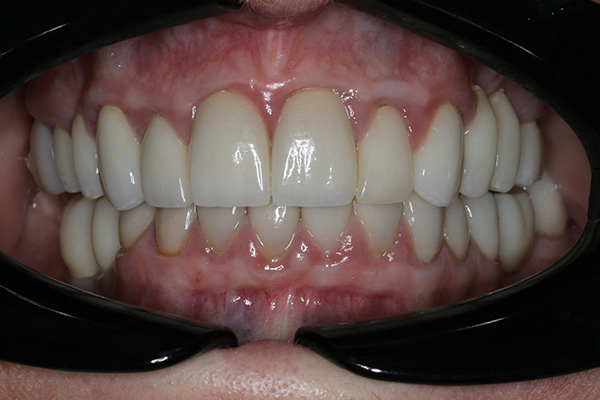Katy Smile Design | Full Mouth Reconstruction, Teeth Whitening and Dental Bridges