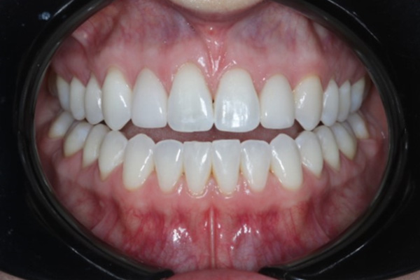 Katy Smile Design | Periodontal Treatment, Implant Restorations and OralID reg  Cancer Screening