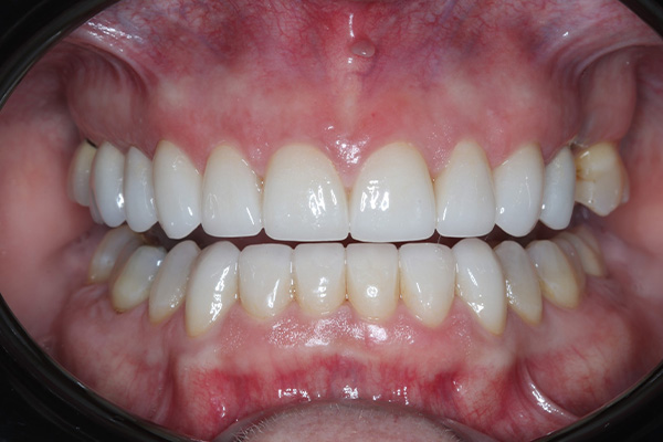 Katy Smile Design | Dental Cleanings, Smile Makeovers and Crowns  amp  Caps