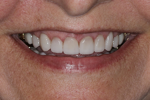 Katy Smile Design | Snoring Appliances, Dental Sealants and Veneers