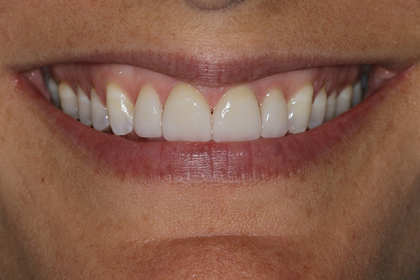 Katy Smile Design | Dental Sealants, Full Mouth Reconstruction and Digital Impressions