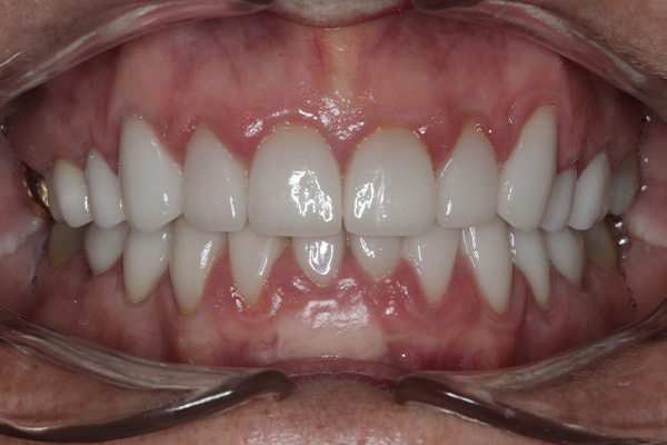 Katy Smile Design | Full Mouth Reconstruction, KöR Whitening and Smile Makeovers