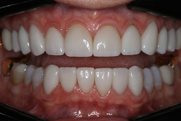 Katy Smile Design | Dental Cleanings, Fluoride Treatment and Intraoral Camera