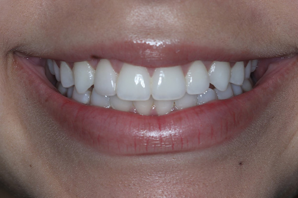 Katy Smile Design | Veneers, Dental Cleanings and Oral Exams