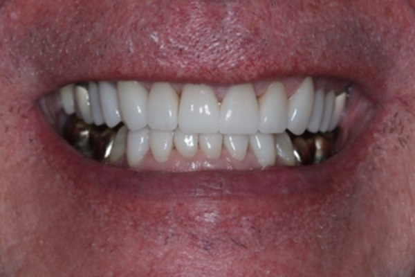 Katy Smile Design | Oral Exams, Invisalign® and Crowns & Caps