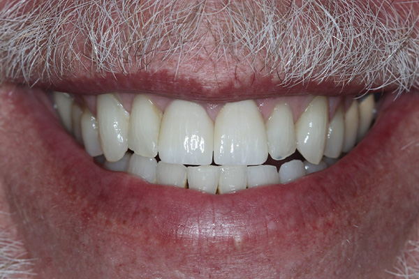 Katy Smile Design | Dental Sealants, Smile Makeovers and Sedation Dentistry