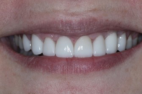 Katy Smile Design | Laser Dentistry, Smile Makeovers and TMJ Disorders