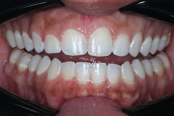 Katy Smile Design | Snoring Appliances, Emergency Treatment and Implant Dentistry