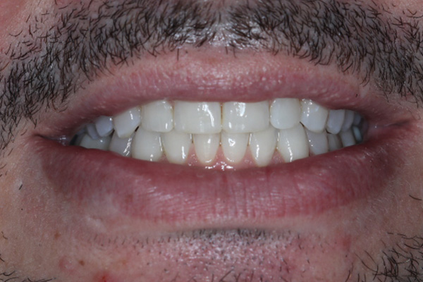 Katy Smile Design | Preventative Program, Dental Fillings and Dental Sealants