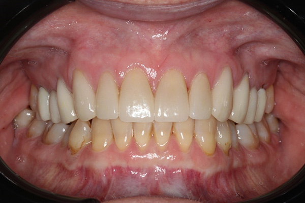 Katy Smile Design | Dental Fillings, KöR Whitening and Implant Restorations