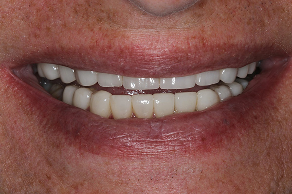 Katy Smile Design | Preventative Program, Smile Makeovers and KöR Whitening