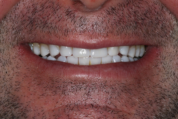 Katy Smile Design | Fluoride Treatment, TMJ Disorders and Smile Makeovers