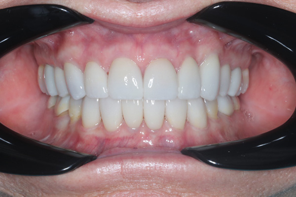 Katy Smile Design | Smile Makeovers, TMJ Disorders and Oral Exams