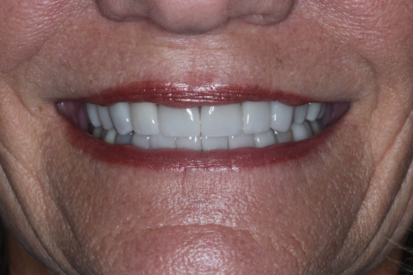 Katy Smile Design | OralID reg  Cancer Screening, Night Guards and Dental Sealants