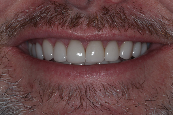 Katy Smile Design | iTero Scanner, OralID reg  Cancer Screening and Oral Cancer Screening