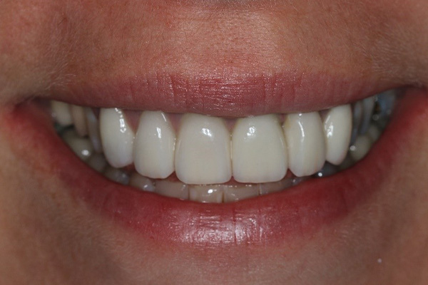 Katy Smile Design | Invisalign reg , Digital Impressions and Night Guards