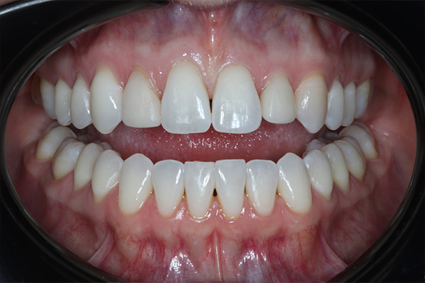 Katy Smile Design | Emergency Treatment, Digital Impressions and Teeth Whitening