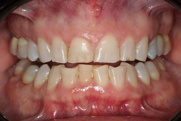 Katy Smile Design | Laser Dentistry, Periodontal Treatment and Implant Dentistry