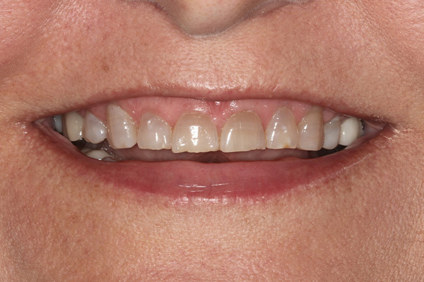 Katy Smile Design | Invisalign reg , Intraoral Camera and Full Mouth Reconstruction