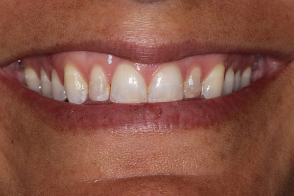 Katy Smile Design | Digital Radiography, Dental Cleanings and Crowns  amp  Caps