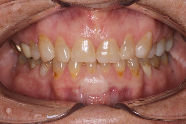 Katy Smile Design | OralID® Cancer Screening, Preventative Program and Oral Cancer Screening