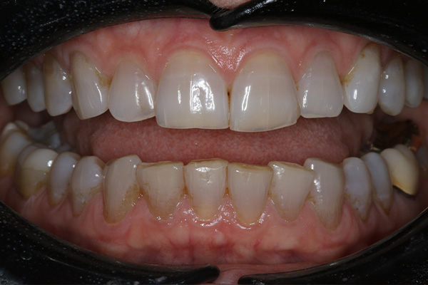 Katy Smile Design | Crowns & Caps, Oral Exams and Laser Dentistry