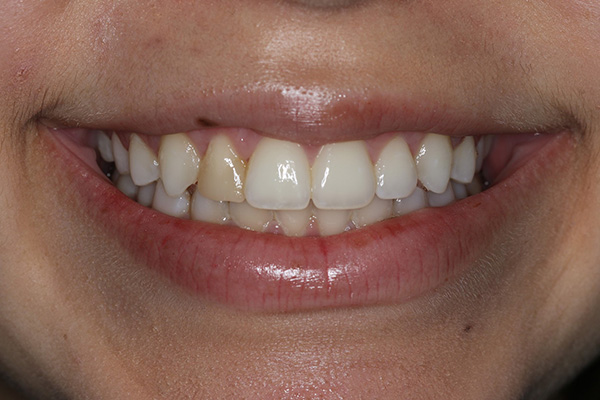 Katy Smile Design | Periodontal Treatment, Dental Bridges and Digital Impressions