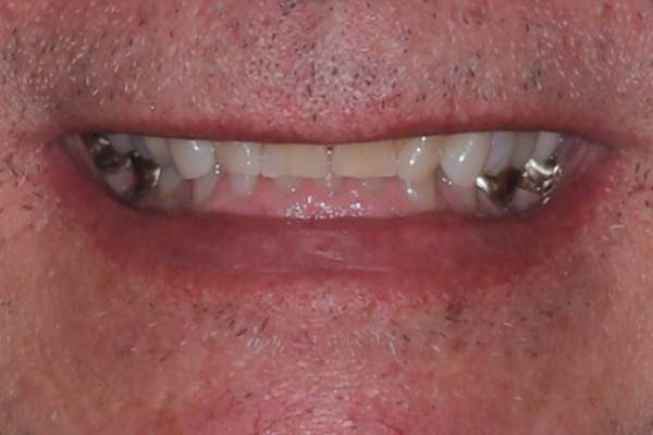 Katy Smile Design | Periodontal Treatment, KöR Whitening and Preventative Program