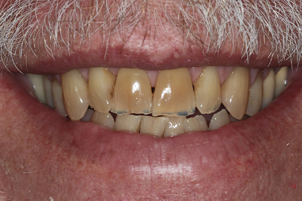 Katy Smile Design | Sleep Apnea, Crowns & Caps and Veneers