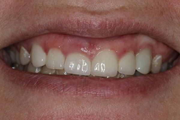 Katy Smile Design | Night Guards, Dental Sealants and Implant Restorations