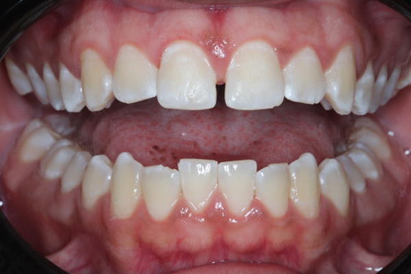 Katy Smile Design | Dental Fillings, Ceramic Crowns and KöR Whitening