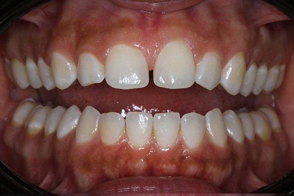 Katy Smile Design | Oral Exams, Digital Impressions and Sleep Apnea