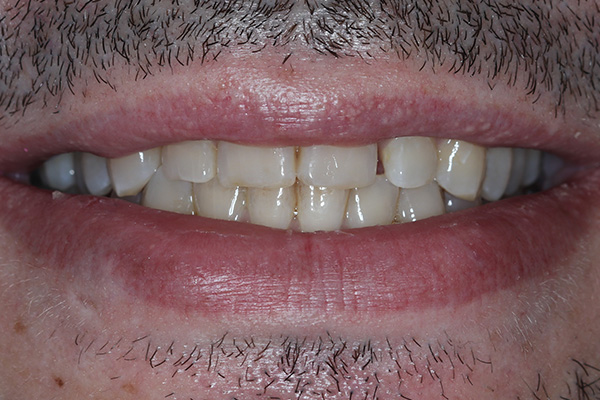 Katy Smile Design | Invisalign®, OralID® Cancer Screening and Smile Makeovers