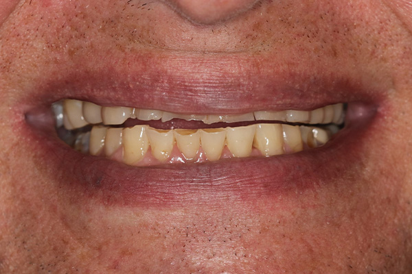 Katy Smile Design | Cosmetic Dentistry, Implant Dentistry and OralID® Cancer Screening