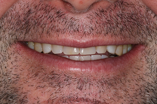 Katy Smile Design | Implant Dentistry, Fluoride Treatment and Invisalign reg 