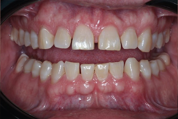 Katy Smile Design | Sleep Apnea, Cosmetic Dentistry and Implant Dentistry