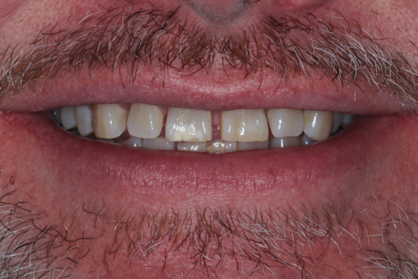 Katy Smile Design | Oral Exams, Full Mouth Reconstruction and iTero Scanner