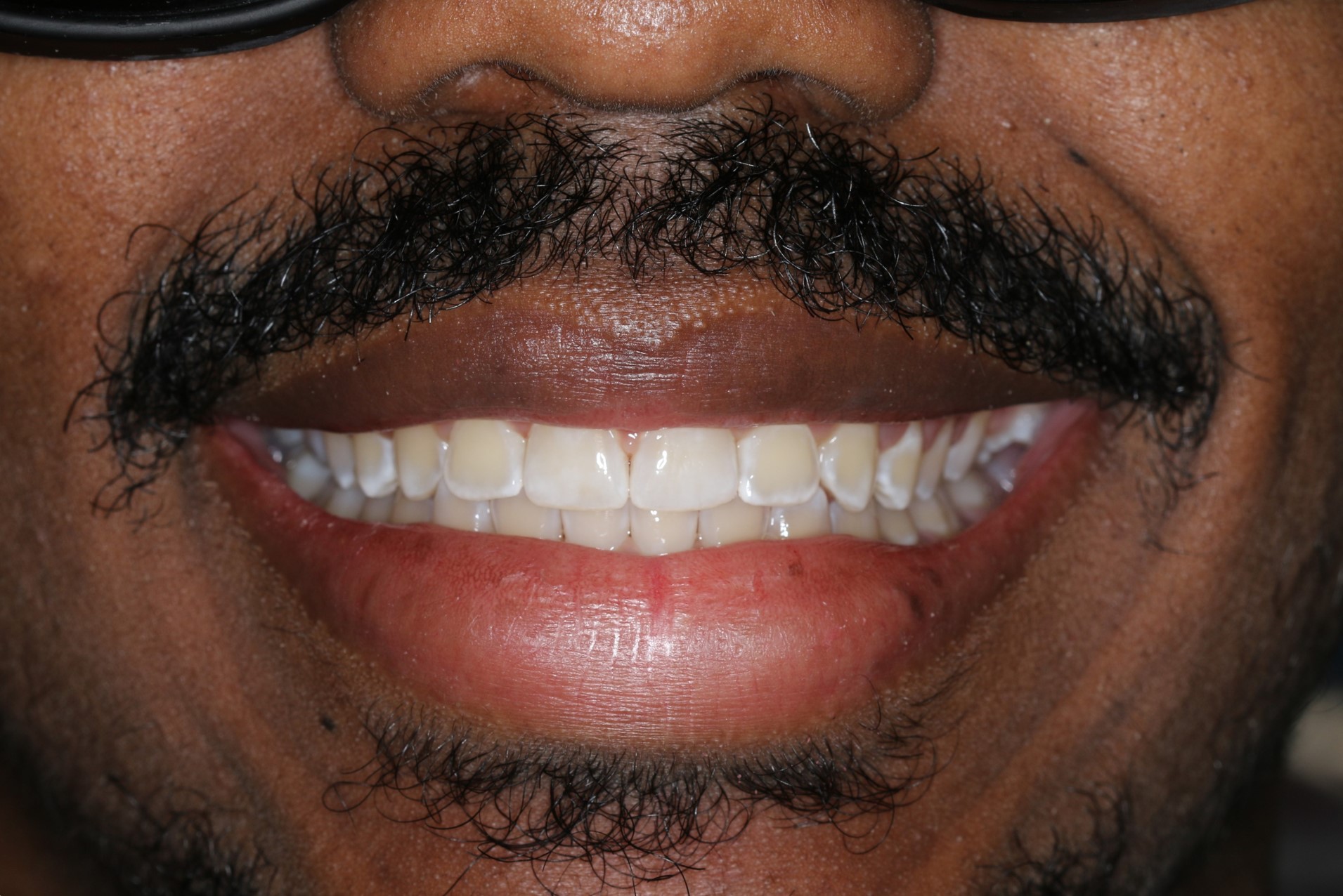 Katy Smile Design | OralID reg  Cancer Screening, Oral Cancer Screening and Smile Makeovers