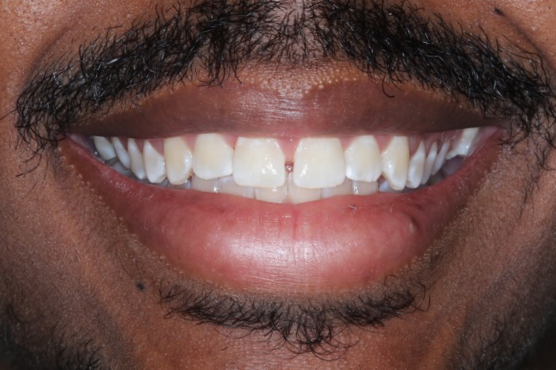 Katy Smile Design | Implant Restorations, Intraoral Camera and Cosmetic Dentistry