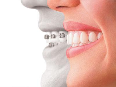 The image features a split-screen comparison between an adult s teeth with braces and a child s teeth without braces, highlighting the transformation of oral health.