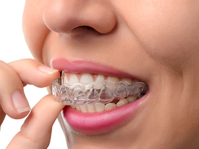 The image shows a person with a clear retainer on their teeth, holding it up to their mouth while looking directly at the camera.