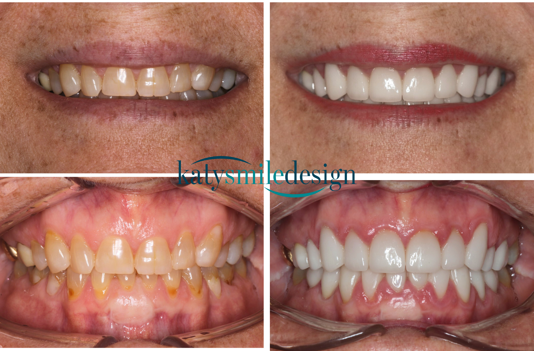 full mouth reconstruction with laser dentistry