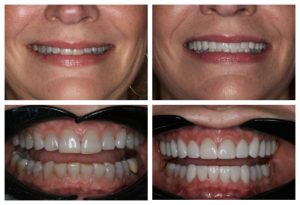 porcelain veneers at Katy Smile Design