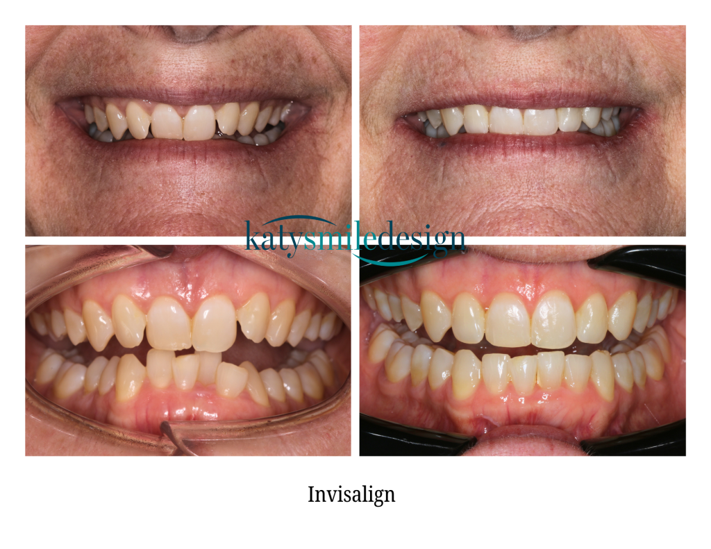 Invisalign treatment at Katy Smile Design