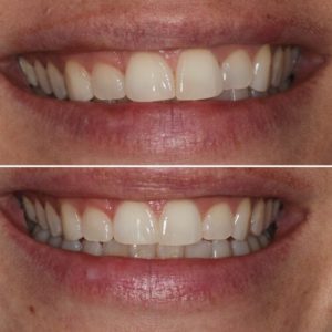 invisalign before and after